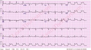 We nurses know what this means too (bad heart attack!!).